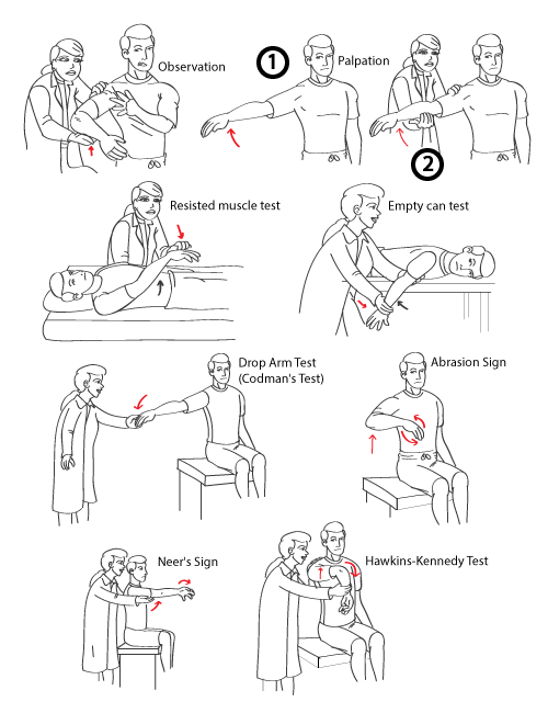 Diagnosing Supraspinatus Tears