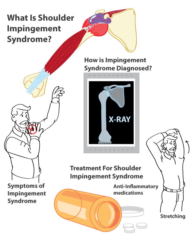 Impingement Syndrome Supraspinatus