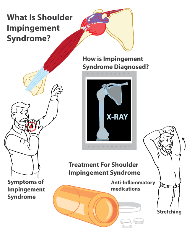 Supraspinatus Injury Information