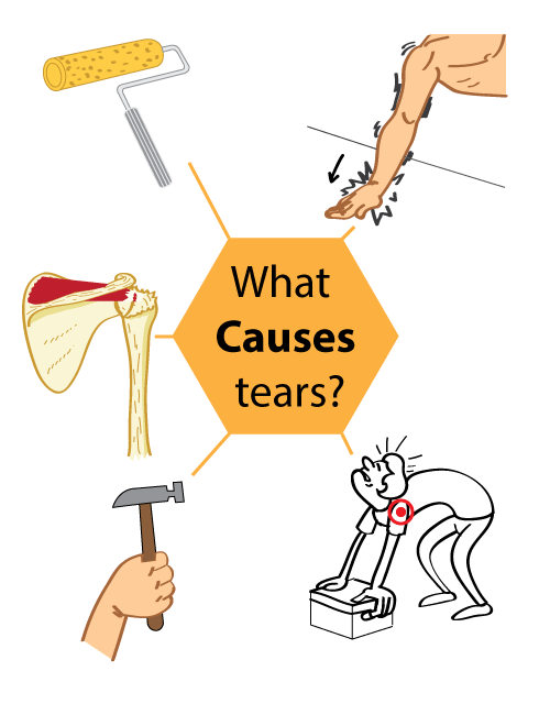 What Causes Supraspinatus