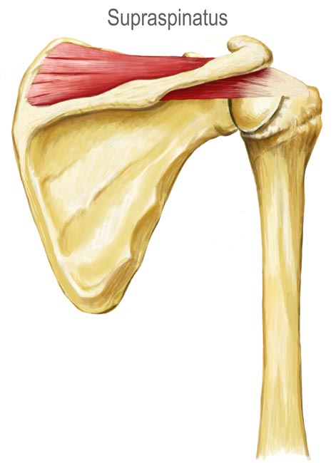 Supraspinatus Tear