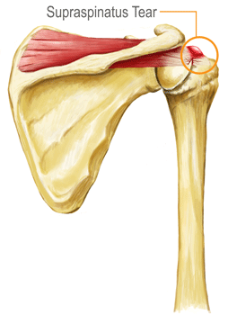 Supraspinatus Tendonitis